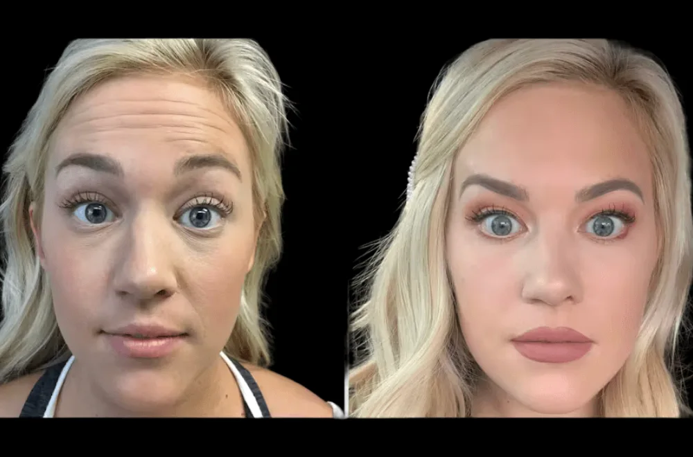 The Rising Popularity of Botox Treatment in Dubai: Why More People Are Choosing It