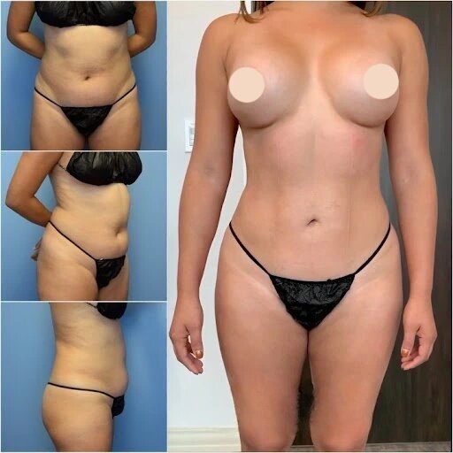 Making the Right Call Choosing Liposuction in Dubai for Your Transformation