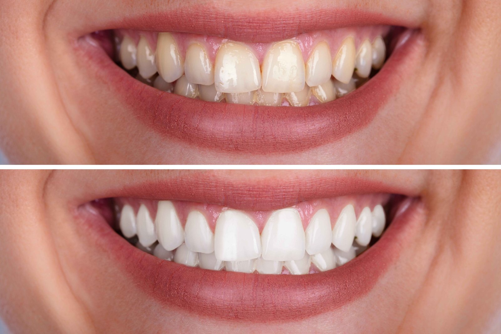 Can Whitening Treatments Eliminate Persistent Tooth Stains?