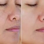brown spot laser treatment
