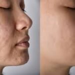 Scar Removal in London: Expert Treatments for Smoother Skin