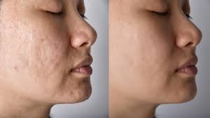 Scar Removal in London: Expert Treatments for Smoother Skin