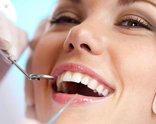 Everything You Need to Know About Dental Implants in Tampa
