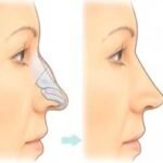 Nose Surgery in Islamabad