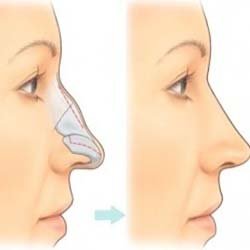 Nose Surgery in Islamabad: Enhancing Appearance and Breathing with Expertise