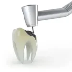 dental filling in islamabad