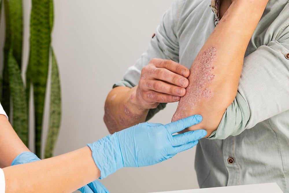 Struggling with Eczema? Visit Dynamic Aesthetic Clinic