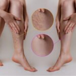 what kind of specialist treats varicose veins