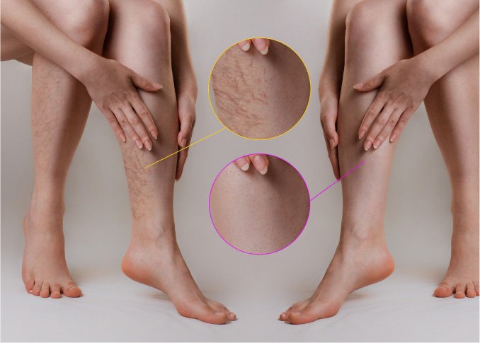 What kind of specialist treats varicose veins effectively?