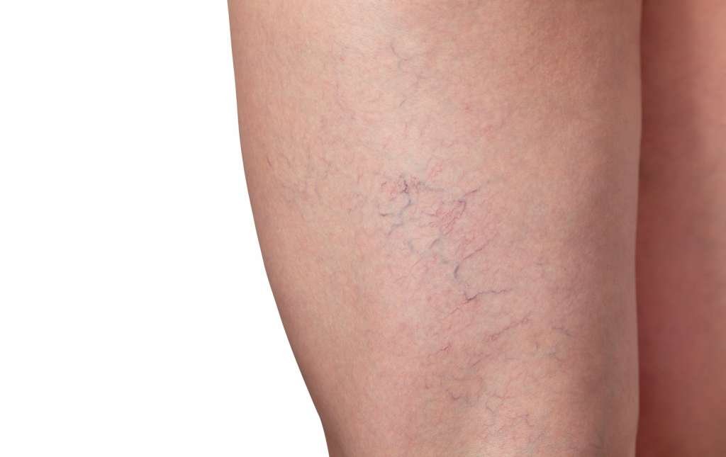Broken capillaries for calm skin at Dynamic Life Clinics
