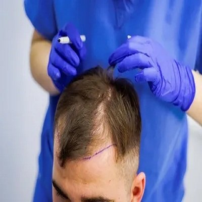 FUE Hair Transplant in riyadh