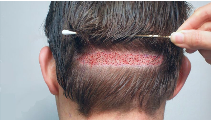 Hair Transplant in Lahore