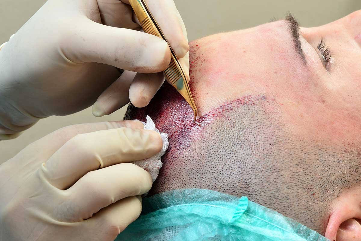 Want Hair Back? Hair Transplant at Dynamic Life Clinics Dubai
