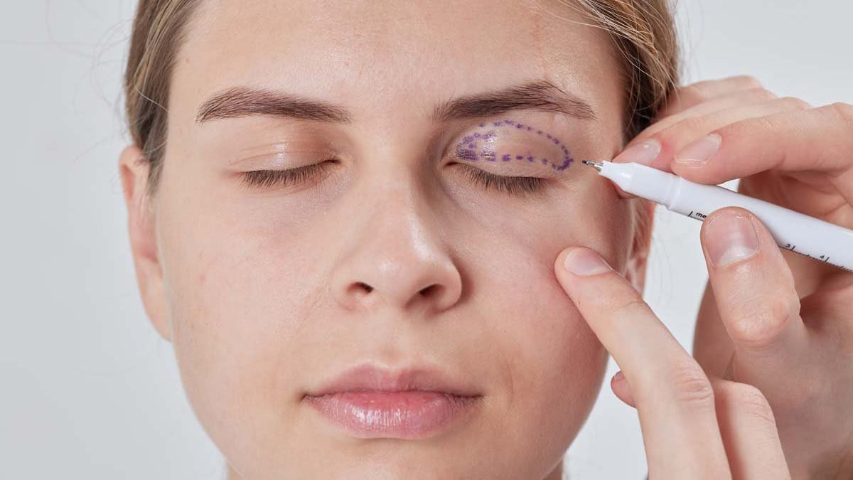 Blepharoplasty Dubai