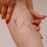 Is it worth getting varicose veins removed?