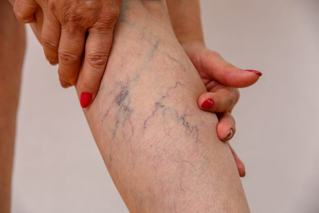 Is It Worth Getting Varicose Veins Removed For Cosmetic Reasons?