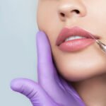 Juvederm filler