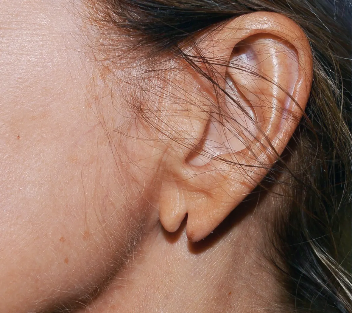 Piercing Trouble? Earlobe Fix at Dynamic Life Clinics