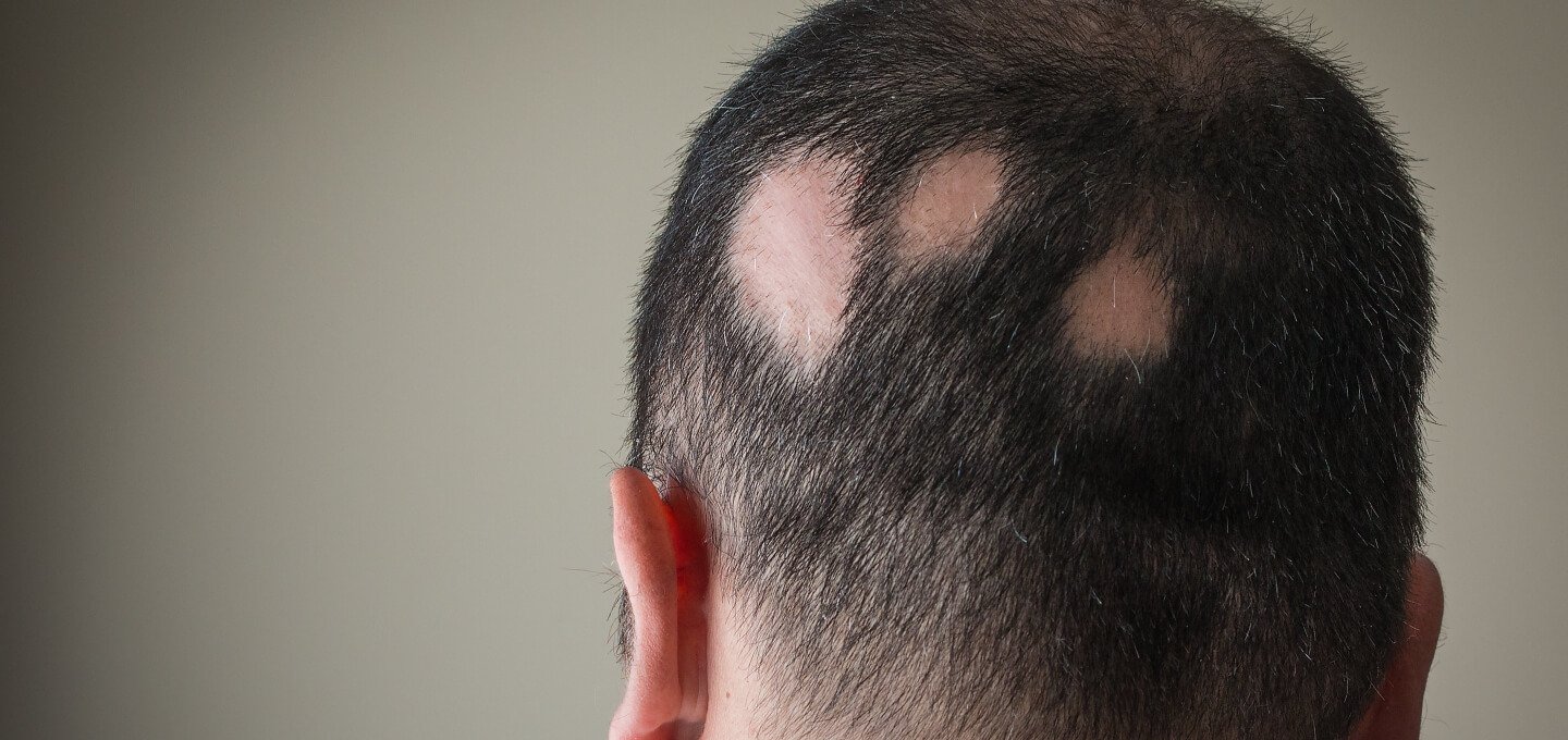 Regrow Bald Spots with Hair Transplant at Dynamic Life Clinics