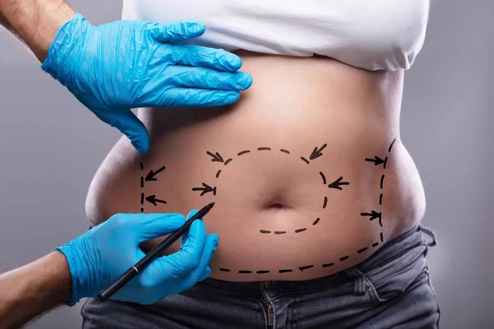 Liposuction Dubai