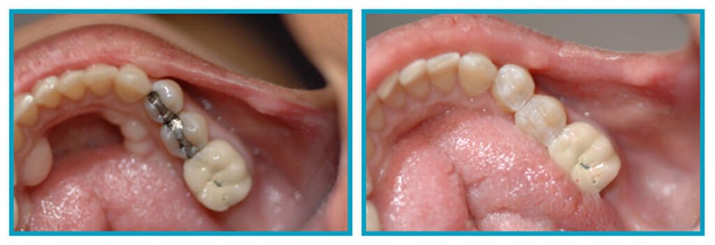 Why Should You Consider Dental Filling in Islamabad for Long-Lasting Oral Health?