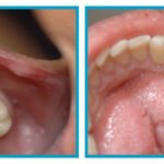 Why Should You Consider Dental Filling in Islamabad for Long-Lasting Oral Health?