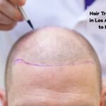 hair transplant cost los angeles