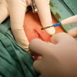 Top Clinics for Lipoma Removal in London: Expert Advice & Reviews