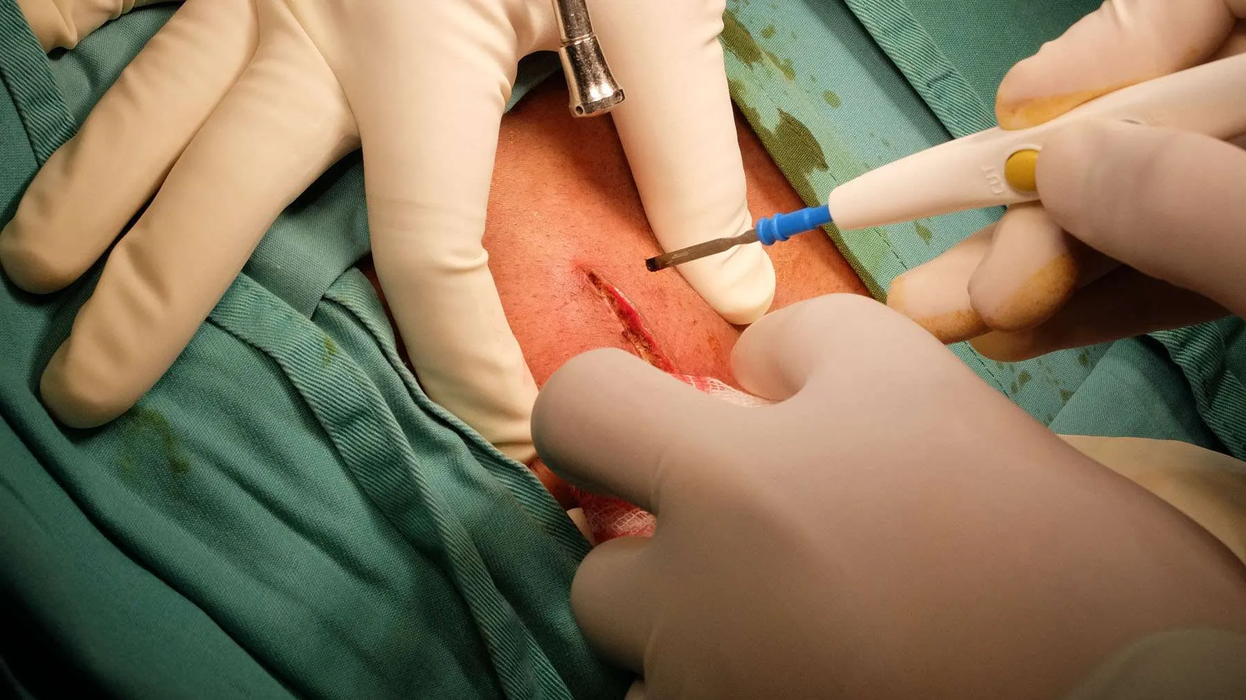 Top Clinics for Lipoma Removal in London: Expert Advice & Reviews