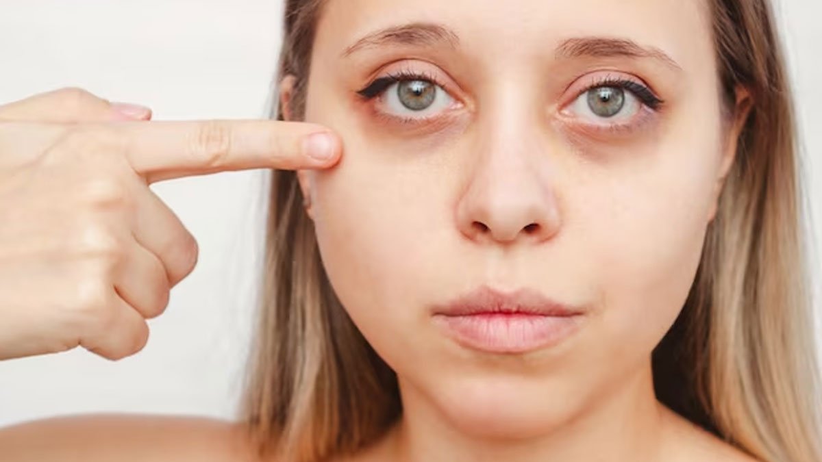 Under eye bags procedure? Refresh at Dynamic Life Clinics