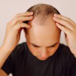 زراعة الشعر في الرياض