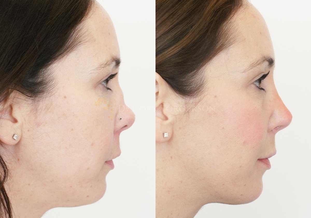 Rhinoplasty Toronto