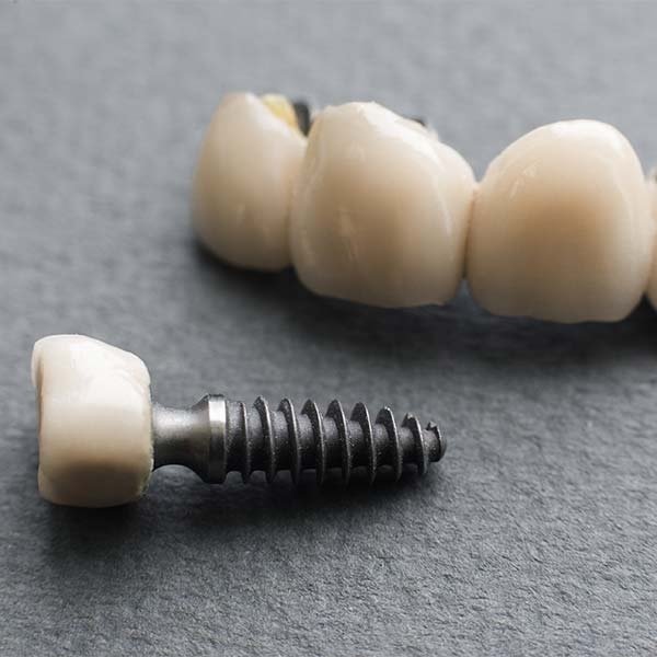 What Are the Benefits of Getting Cosmetic Dental Implants?