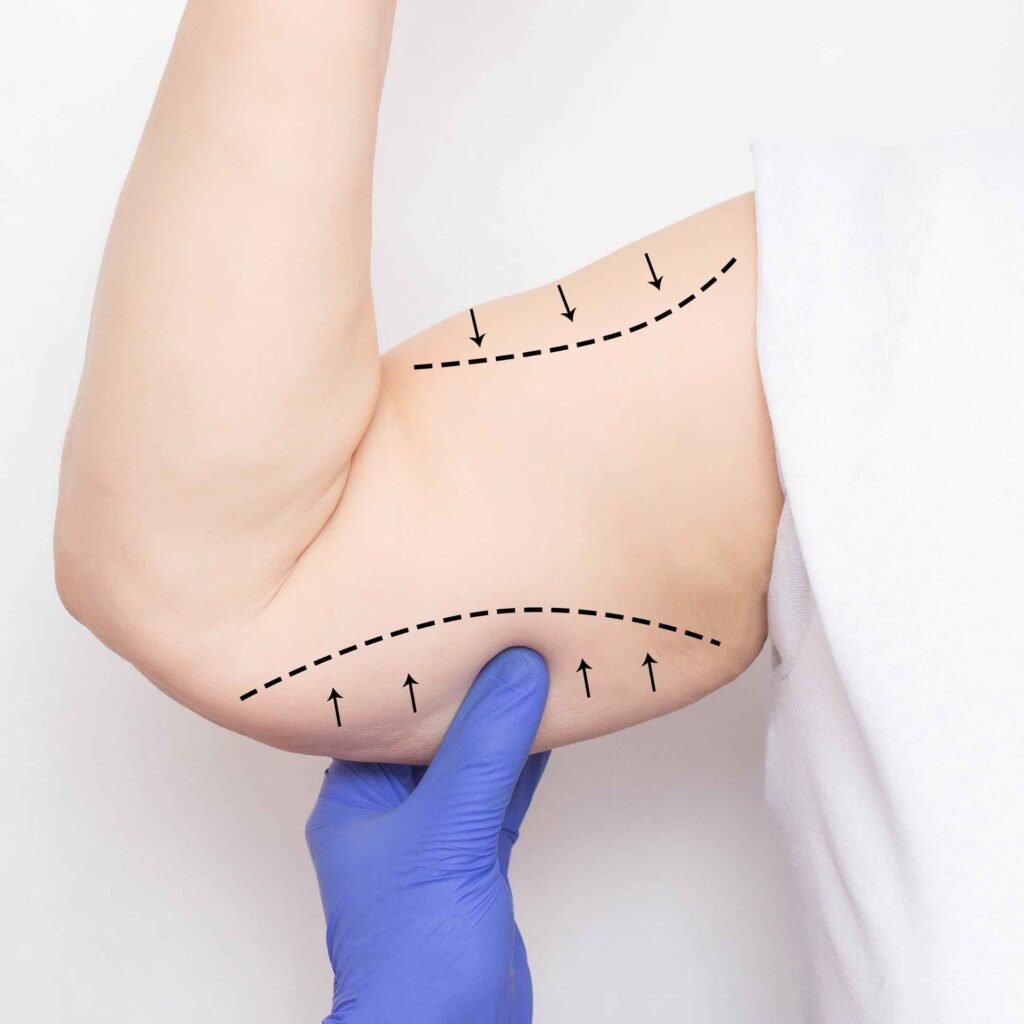 Arm Lift Surgery in Dubai