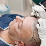 Hair Transplant in Dubai