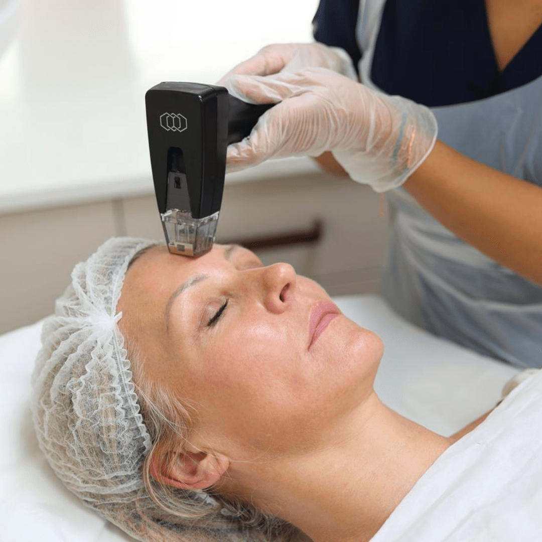 Can Morpheus8 Revive Dull or Tired-Looking Complexion?