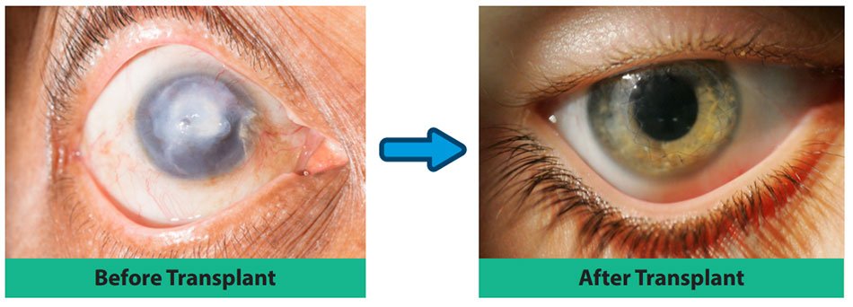 Advanced Eye Care at the Best Cornea Transplant Hospital in Karnal – Arora Eye Centre