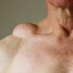 Lipoma Treatment in Dubai