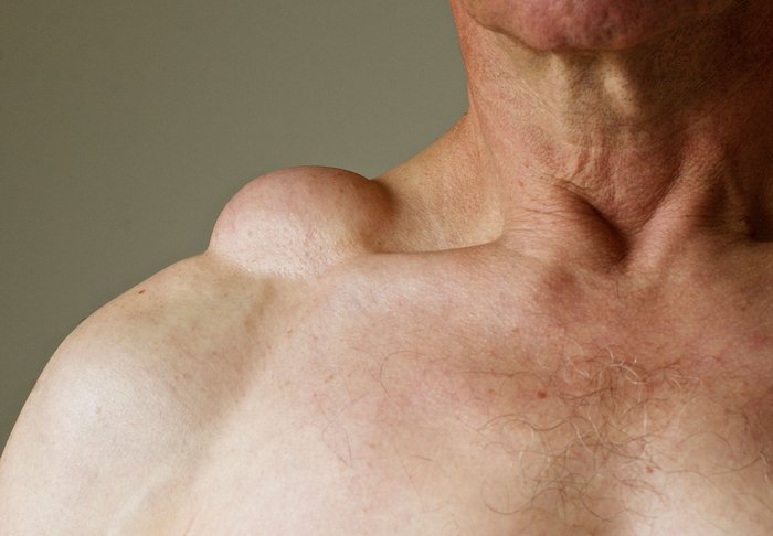 Lipoma Treatment in Dubai