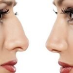 Rhinoplasty in Riyadh