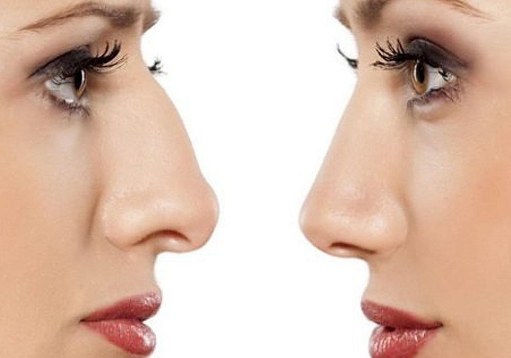 Advanced Techniques in Nasal Reconstruction and Repair in Riyadh