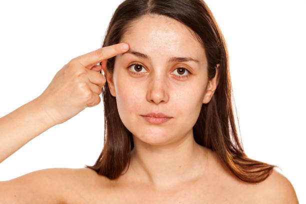 Eyebrow Lift Dubai