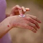 best eczema treatment in Dubai