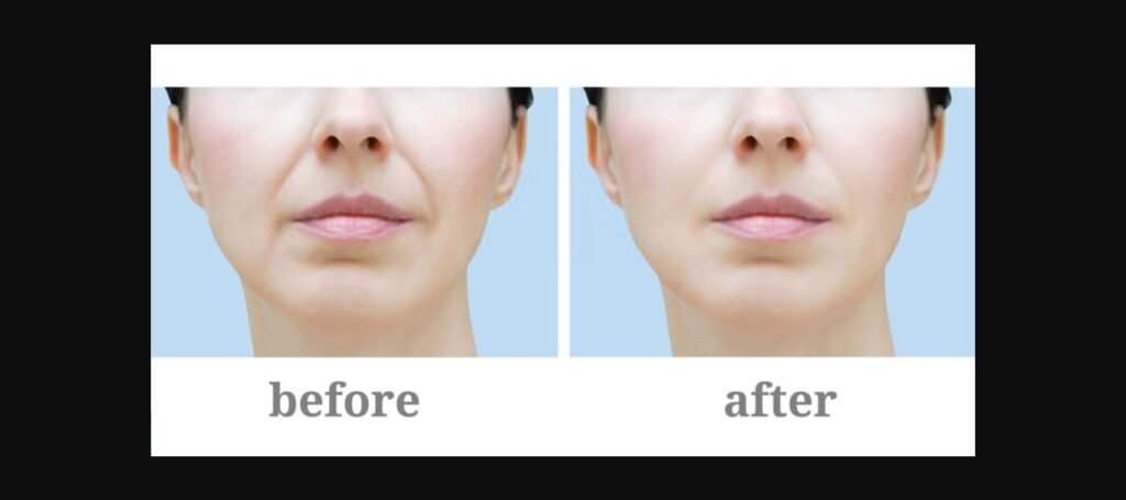 Botox chin before and after results showing smoother, more youthful chin with reduced dimpling at SF Aesthetic Medspa.