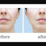Botox chin before and after results showing smoother, more youthful chin with reduced dimpling at SF Aesthetic Medspa.