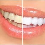 Teeth Whitening in Aberdeen: Achieve a Brighter Smile