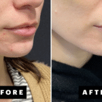 Why Over-the-Counter Treatments Often Fail for Cystic Acne 
