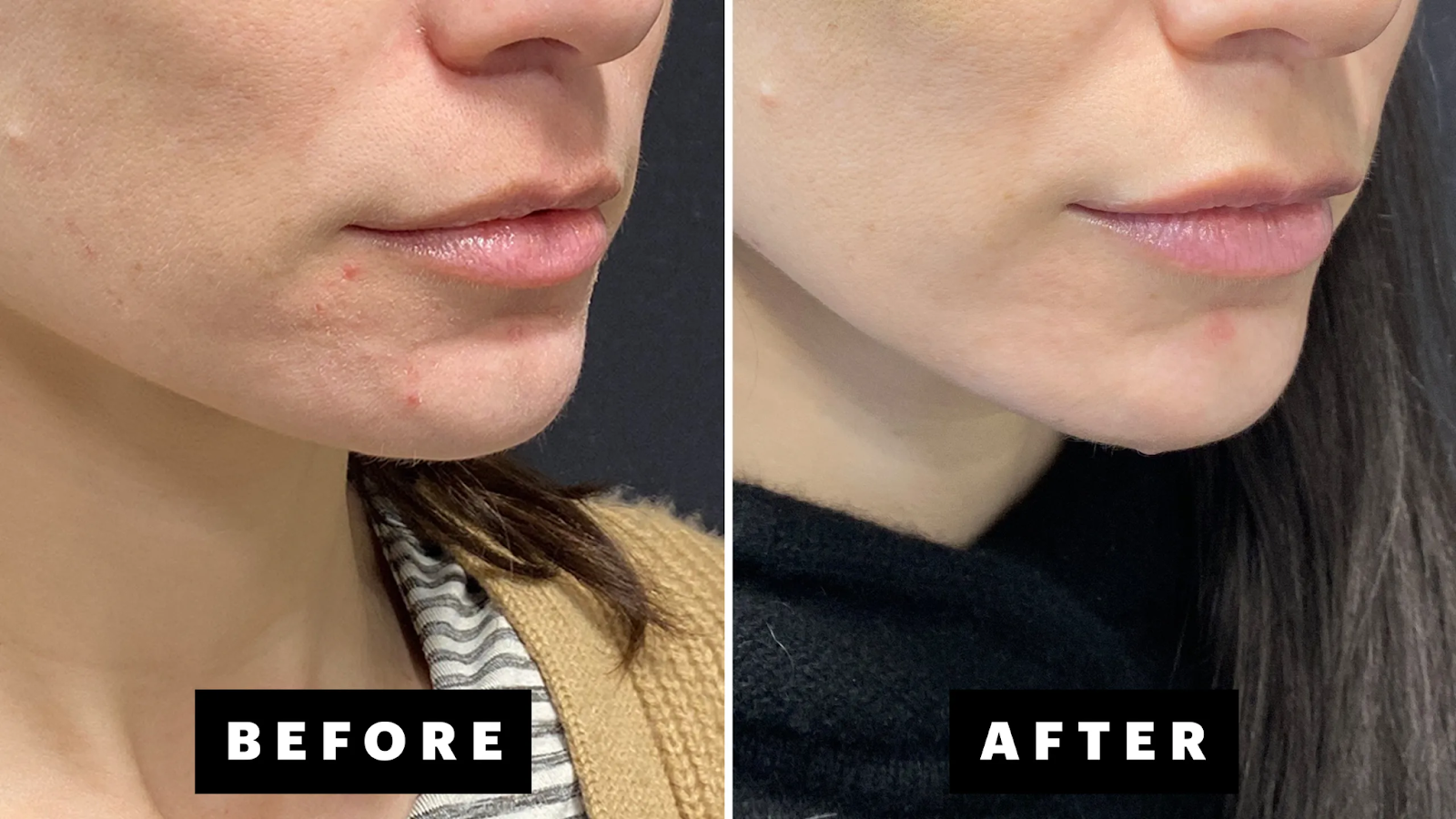 Why Over-the-Counter Treatments Often Fail for Cystic Acne 