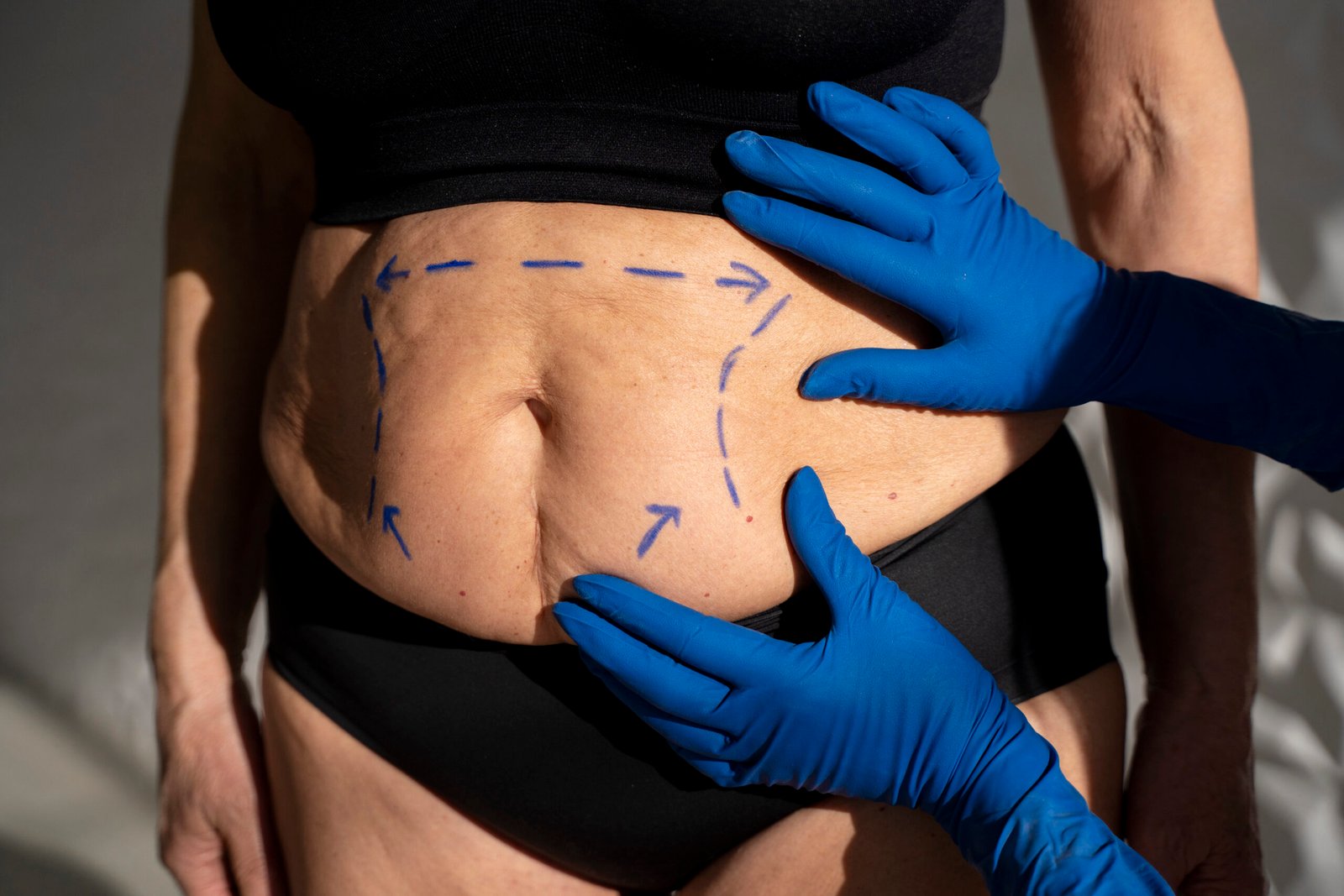 tummy tuck in Hyderabad