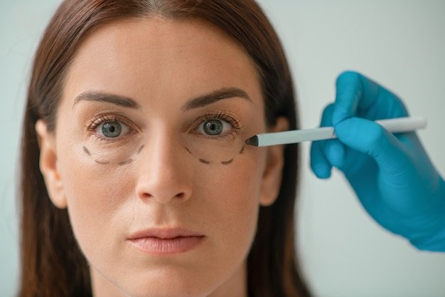 Under-Eye Filler Treatment in Dubai